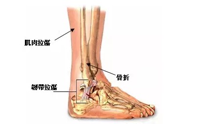 局部疼痛青肿一般都是韧带损伤,此外,受伤程度越大,肿胀和青紫程度越